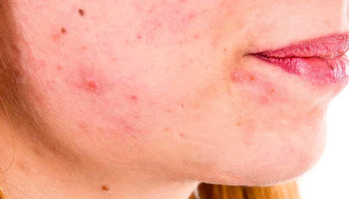 Tratamento para dermatite atopica e acne - dra andreia pamplona