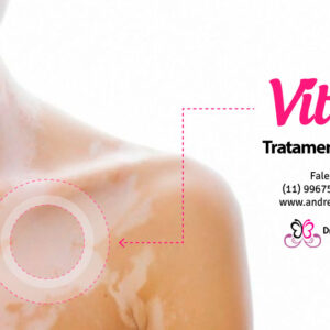 Tratamento para vitiligo - Dra Andréia Pamplona