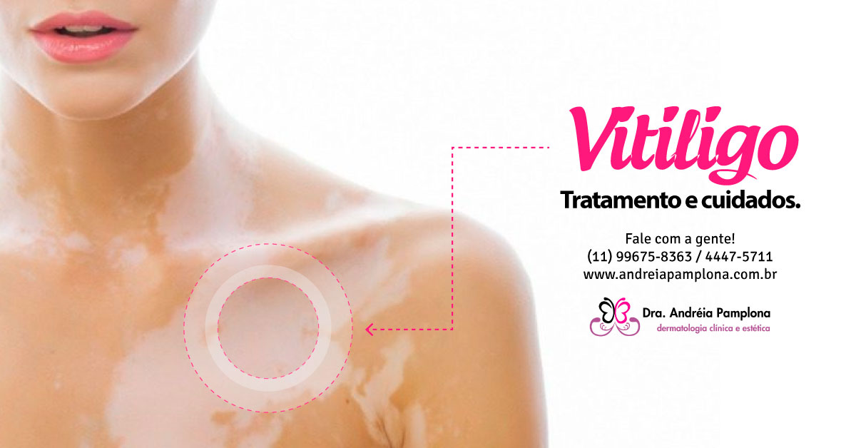 Tratamento para vitiligo - Dra Andréia Pamplona