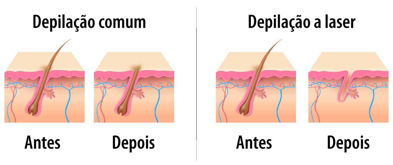 Como funciona a depilação a laser