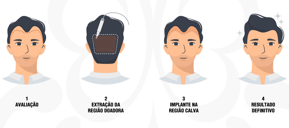 Como e feito transplante capilar - www.andreiapamplona.com.br