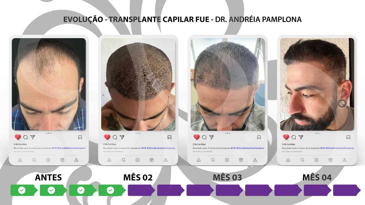 Quanto tempo leva para ver os resultados do Transplante Capilar FUE?