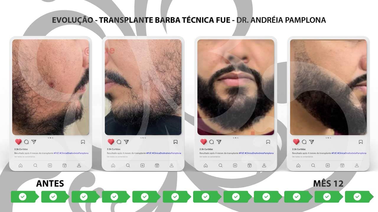 transplante-barba-tecnica-fue-andreia-pamplona