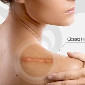 Cicatriz Hipertrófica