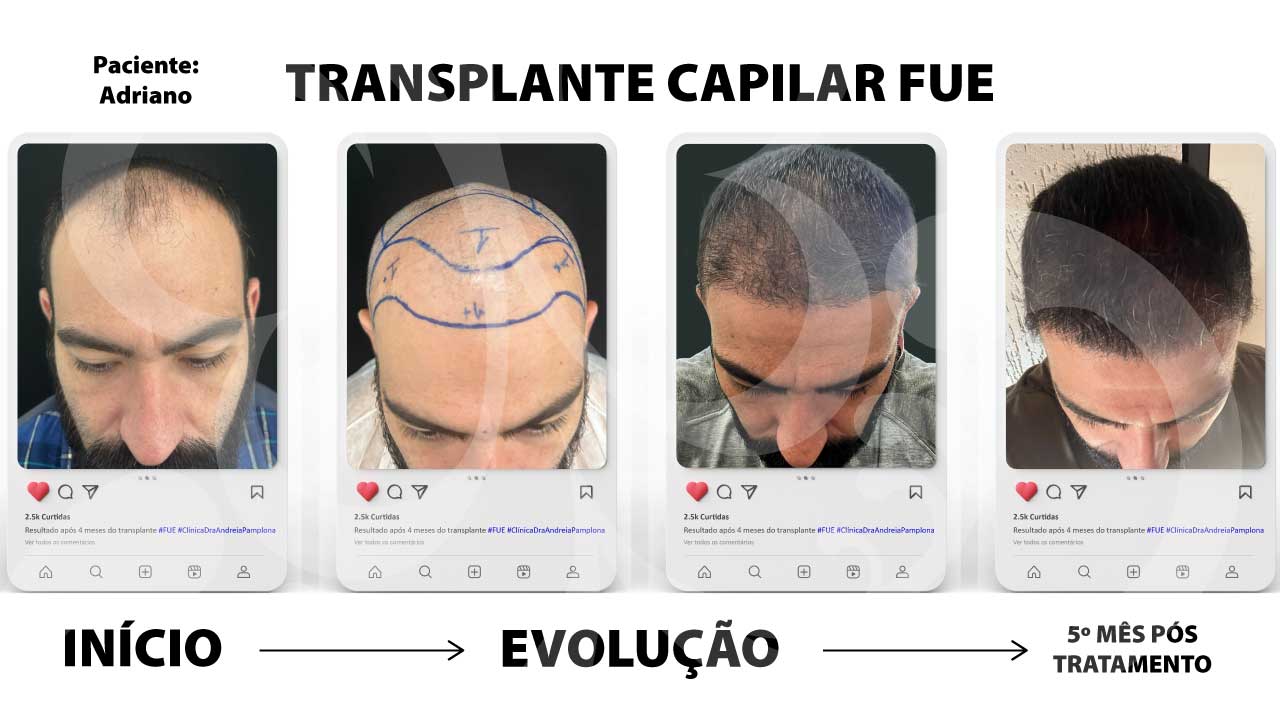 Mitos e verdades sobre o transplante capilar FUE