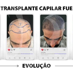 Mitos e verdades sobre o transplante capilar FUE