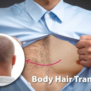 transplante capilar body hair transplant - BHT