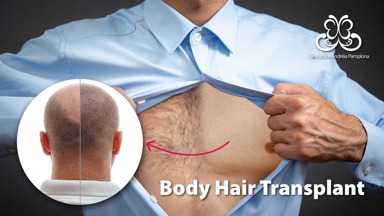 transplante capilar body hair transplant - BHT