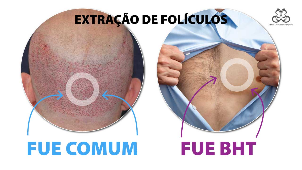 Transplante Capilar FUE vs. Body Hair Transplant